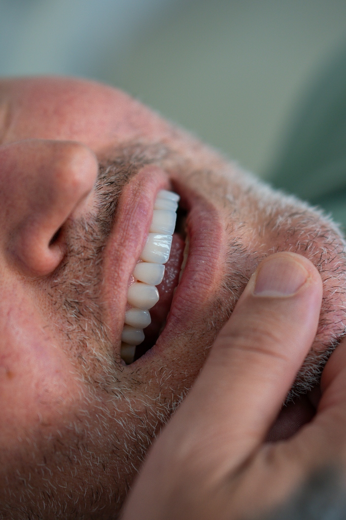 Facetas Dentárias Porcelana e Resina