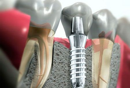 Implantes Dentários Ataya Concept